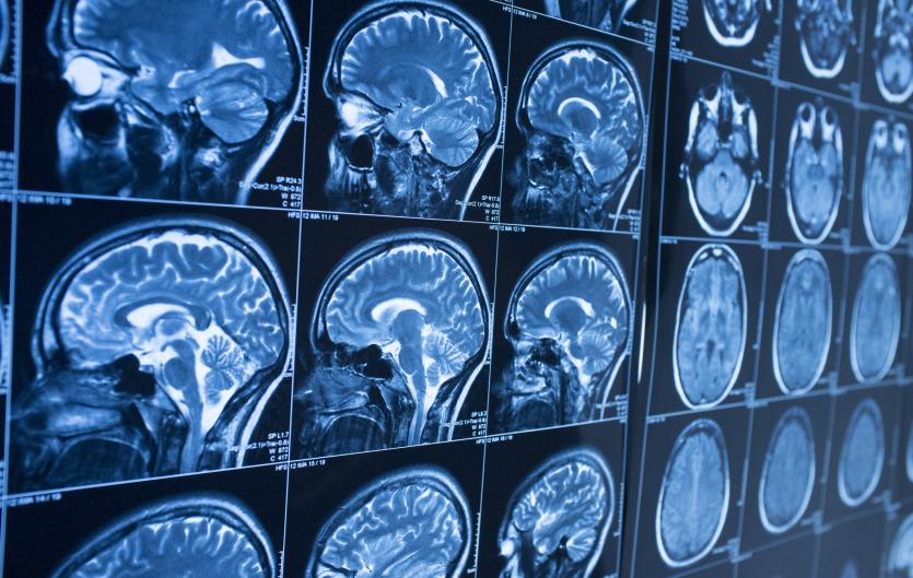 Research Pictures of brain scans