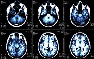 Six brain scans from an MRI scan