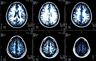 Six MRI brain scan images