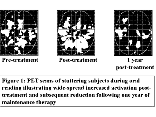 PET scans of people who stutter